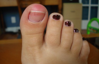 Inflamed-finger-or-toe-whatisusa.info